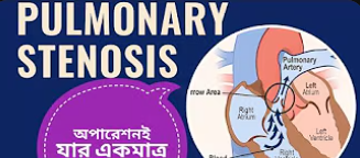 হার্টের আন-কমন রোগ recurrent pulmonary stenosis | অপারেশনই যার একমাত্র চিকিৎসা |